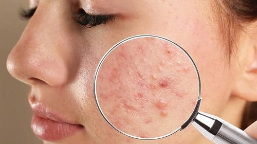 Sử dụng bột hương nhu để điều trị mụn