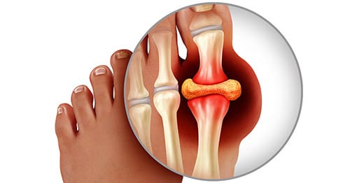 Cải thiện bệnh gout nhờ hoàng bá nguyên chất